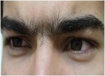 Unibrow